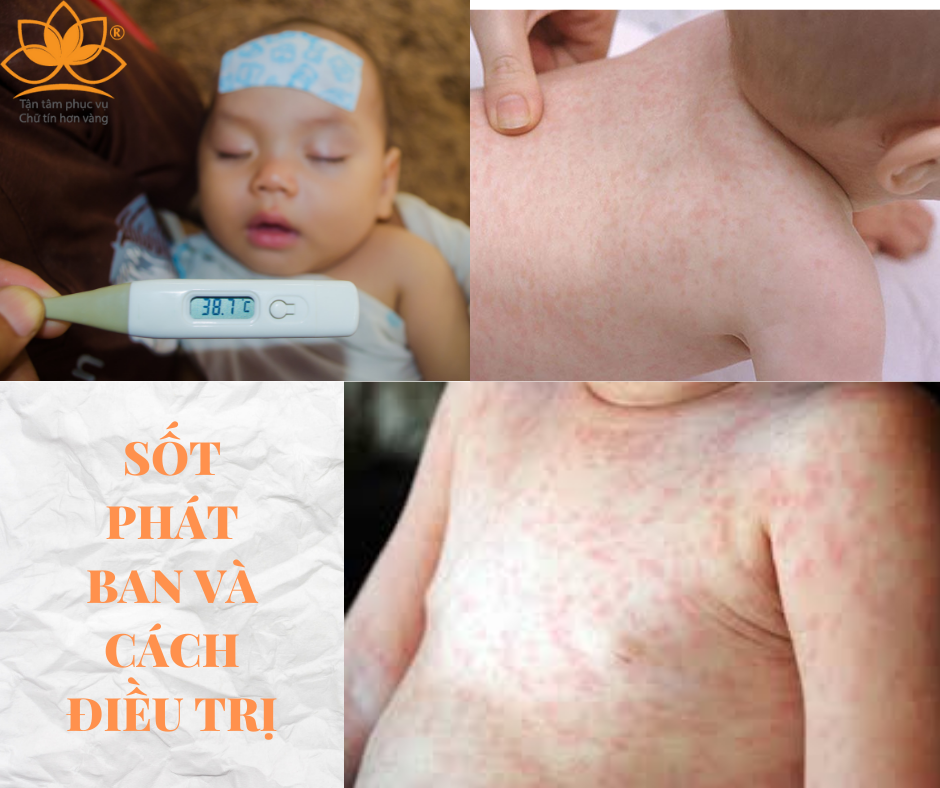 SỐT PHÁT BAN Ở TRẺ NHỎ